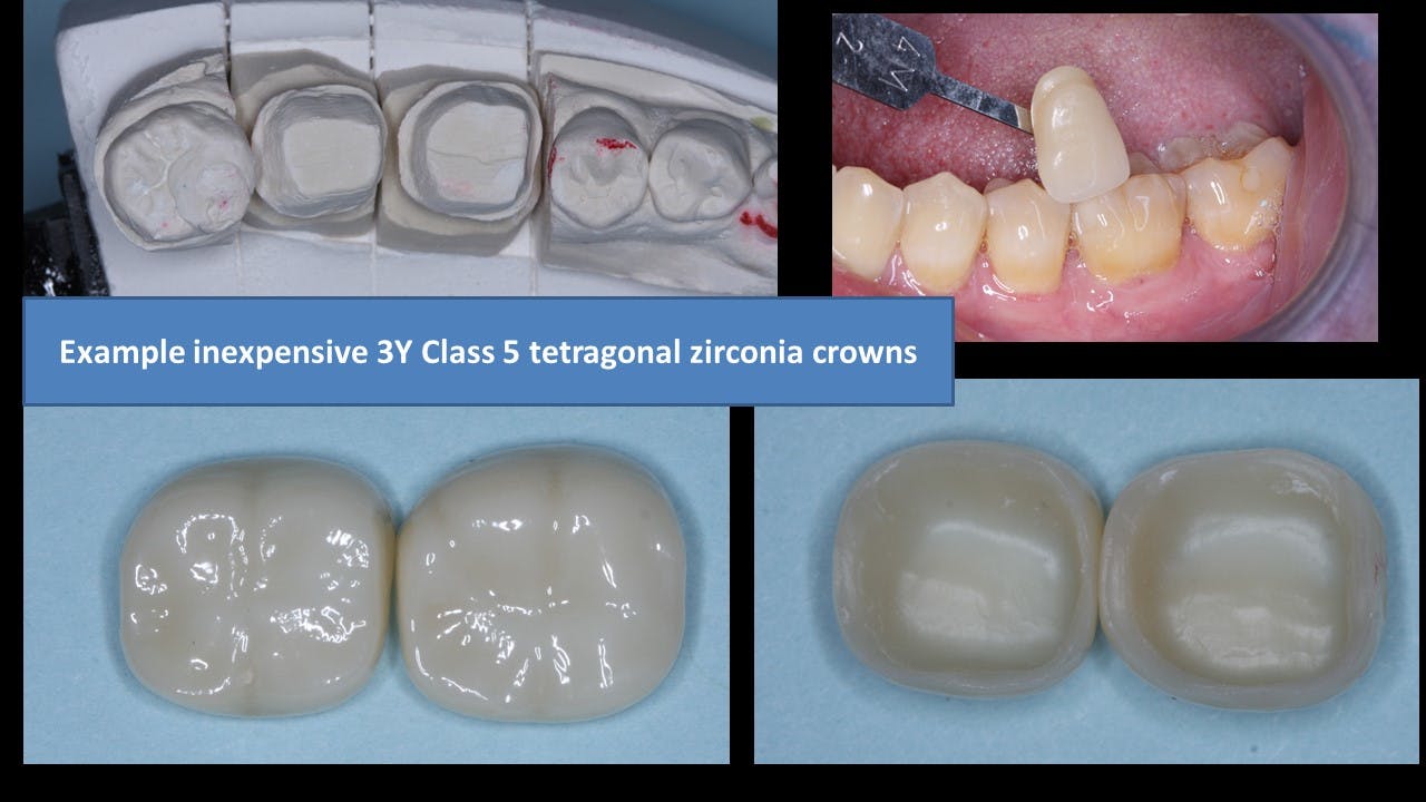 Figure 2: External staining and glazing of zirconia is commonly accomplished in dentistry. Unfortunately, it has some negative characteristics over the long term.