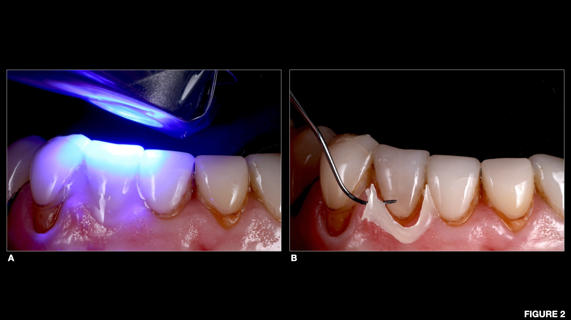 Clinical case studies Streamlined dental cementation protocol for low