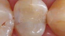Figure 4: Amalgam replaced using Omnichroma Blocker Flow and Omnichroma Flow Figure 4: Amalgam replaced using Omnichroma Blocker Flow and Omnichroma Flow
