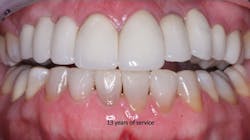 Figure 1: Which crowns are over implants, and which crowns are over natural teeth? If every aspect of the respective procedures is accomplished adequately, it is impossible to tell the difference. At the time of this slide, the treatment has served for 13 years, and the implant-supported restorations and surrounding gingival tissues are similar. Figure 1: Which crowns are over implants, and which crowns are over natural teeth? If every aspect of the respective procedures is accomplished adequately, it is impossible to tell the difference. At the time of this slide, the treatment has served for 13 years, and the implant-supported restorations and surrounding gingival tissues are similar.