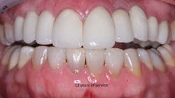 Figure 1: Which crowns are over implants, and which crowns are over natural teeth? If every aspect of the respective procedures is accomplished adequately, it is impossible to tell the difference. At the time of this slide, the treatment has served for 13 years, and the implant-supported restorations and surrounding gingival tissues are similar. Figure 1: Which crowns are over implants, and which crowns are over natural teeth? If every aspect of the respective procedures is accomplished adequately, it is impossible to tell the difference. At the time of this slide, the treatment has served for 13 years, and the implant-supported restorations and surrounding gingival tissues are similar.