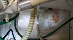 In dental treatment room is cabinetry for exit of suction line and space for dental handpieces on an extended arm. Note used torn glove fingertip on suction line, white suction tip used in patient’s mouth, clear plastic barrier for digital x-ray cover, diamond bur used in patient’s mouth, used blue injection needle cap, a “made in China” supply label, and human blood splatter from leaks in suction line.