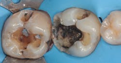 Figure 3: Amalgam removed Figure 3: Amalgam removed