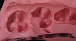 Figure 4: After preparation refinement, an alginate impression is done Figure 4: After preparation refinement, an alginate impression is done