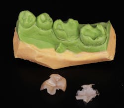 Figure 7: The flexibility in the middle of the model allows for easy removal of the restorations. Figure 7: The flexibility in the middle of the model allows for easy removal of the restorations.