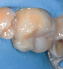 Figure 10: Cementation Figure 10: Cementation