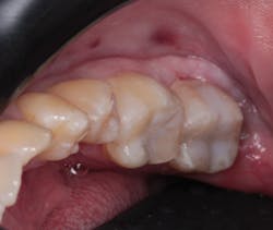 Figure 11: Final restoration Figure 11: Final restoration