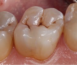 Figure 2: Lingual restoration with Omnichroma Flow only Figure 2: Lingual restoration with Omnichroma Flow only