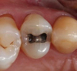Figure 3: Premolar with amalgam that requires replacement