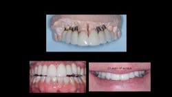 Figure 2: The two central incisor crowns and the first premolar crown are on natural teeth; the remainder of the crowns are over implants. Despite implant angulation challenges and differences in tooth size, these restorations are serving well. Careful and continued occlusal adjustment is necessary to keep the natural teeth in optimum proximal contact with the nonmoving implant-supported crowns. Figure 2: The two central incisor crowns and the first premolar crown are on natural teeth; the remainder of the crowns are over implants. Despite implant angulation challenges and differences in tooth size, these restorations are serving well. Careful and continued occlusal adjustment is necessary to keep the natural teeth in optimum proximal contact with the nonmoving implant-supported crowns.