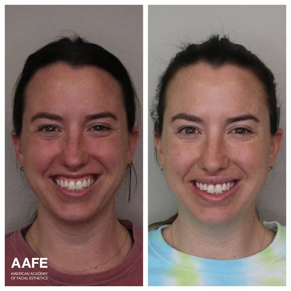 Botox and fillers for gummy smile treatment