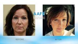 Figure 1: Amazing transformation with Botox and fillers.