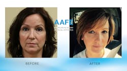 Figure 1: Amazing transformation with Botox and fillers. Figure 1: Amazing transformation with Botox and fillers.