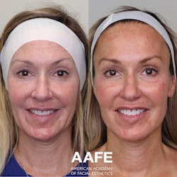 Figure 2: Botox and fillers dramatically improve this patient&rsquo;s smile/lip lines and dental esthetics.