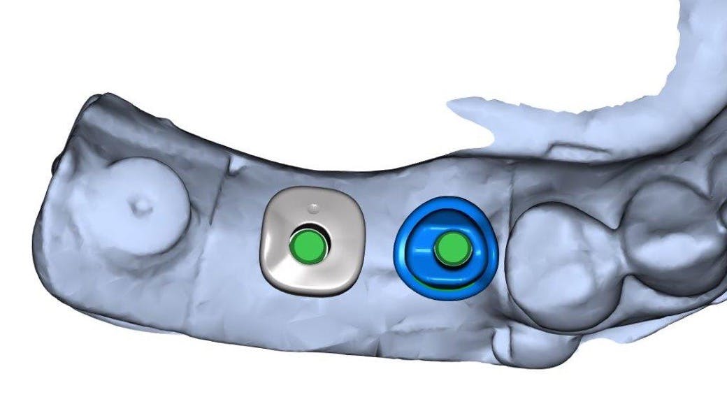 Figure 3: The digital design of custom healing abutments on a digital model. Note the improvements in the contour when compared to the adjacent round stock healing abutment.