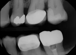 Figure 1: Radiograph of failing class II composite restoration Figure 1: Radiograph of failing class II composite restoration