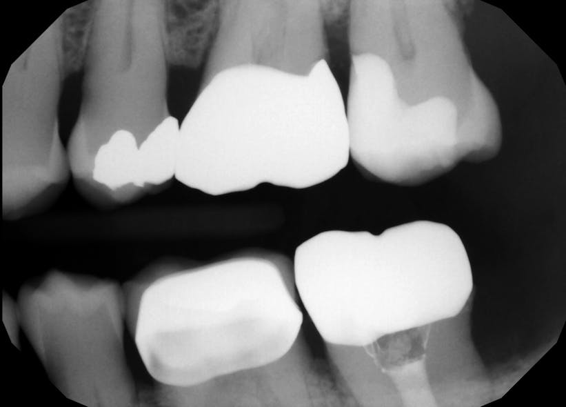 Figure 2: VisCalor bulk restoration with sealed gingival margin and well-contoured and tight interproximal contact