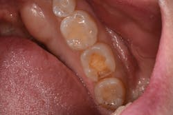 Figure 3: Class II DO preparation of mandibular left second molar