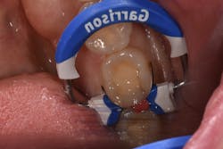 Figure 4: Class II DO preparation banded and wedged. VisCalor bulk is heated and flowed into the distal box, adapting well to the walls, floor, and matrix band. Figure 4: Class II DO preparation banded and wedged. VisCalor bulk is heated and flowed into the distal box, adapting well to the walls, floor, and matrix band.