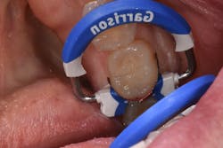 Figure 5: VisCalor bulk becomes sculptable as it cools to body temperature, allowing compression against the matrix band for tight contact and carving of the anatomy. Figure 5: VisCalor bulk becomes sculptable as it cools to body temperature, allowing compression against the matrix band for tight contact and carving of the anatomy.