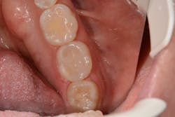 Figure 6: Completed class II thermoviscous bulk-fill composite with VisCalor bulk Figure 6: Completed class II thermoviscous bulk-fill composite with VisCalor bulk
