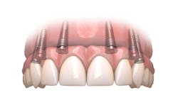 Figure 1: Maxillary full arch Figure 1: Maxillary full arch