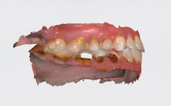 Figure 4: Trios scan (right) Figure 4: Trios scan (right)
