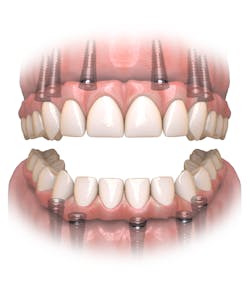 Figure 7: Full-arch path Figure 7: Full-arch path