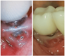 Figure 1: Failing implant saved by the use of chlorine dioxide Figure 1: Failing implant saved by the use of chlorine dioxide