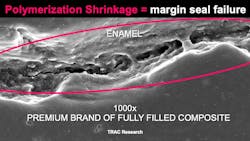 Figure 1: An electron microscopic in vivo photo of the margins of a premium brand of fully filled composite resin. The open margins are even wider with flowable resins than with fully filled composite resins. Figure 1: An electron microscopic in vivo photo of the margins of a premium brand of fully filled composite resin. The open margins are even wider with flowable resins than with fully filled composite resins.