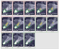 Figure 1: CBCT cross-sections of implant planning Figure 1: CBCT cross-sections of implant planning