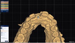 Figure 2: Implant plan brought into CAD, digitally making an emergence profile Figure 2: Implant plan brought into CAD, digitally making an emergence profile