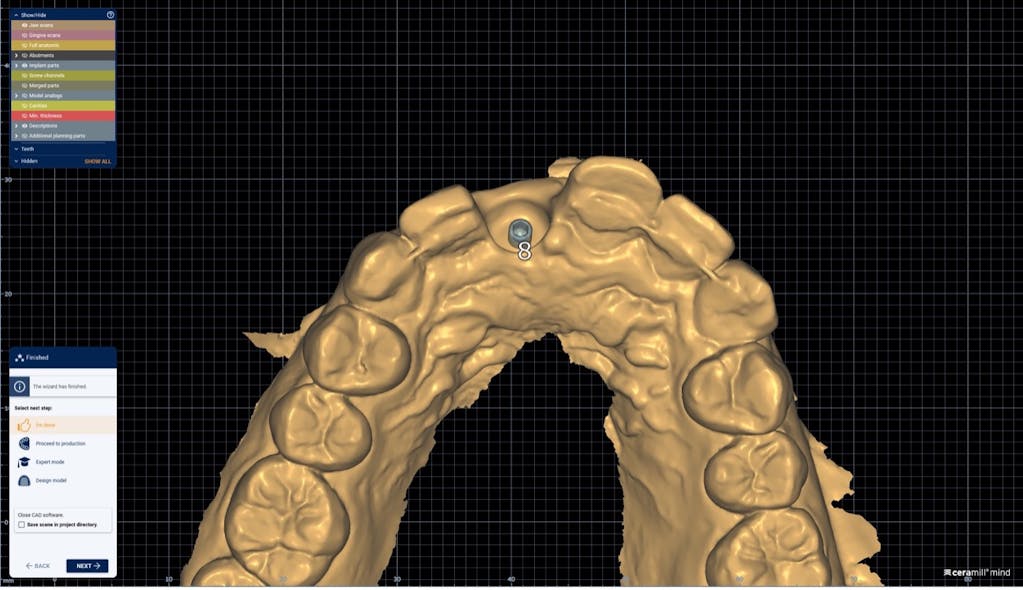 Figure 2: Implant plan brought into CAD, digitally making an emergence profile