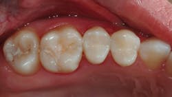 Figure 3: Well-placed class II composites take time, meticulous care, and the proper materials. Don’t sacrifice their quality by using flowables. Here, the second premolar has an MOD and the first premolar has a DO, both restored with fully filled composite material at two years of service. The two sealants in the molars show the common challenges with sealants: broken margins, wear, and caries. Reduce or eliminate those problems by using flowables as the sealant, along with the other steps discussed in this article. Figure 3: Well-placed class II composites take time, meticulous care, and the proper materials. Don’t sacrifice their quality by using flowables. Here, the second premolar has an MOD and the first premolar has a DO, both restored with fully filled composite material at two years of service. The two sealants in the molars show the common challenges with sealants: broken margins, wear, and caries. Reduce or eliminate those problems by using flowables as the sealant, along with the other steps discussed in this article.