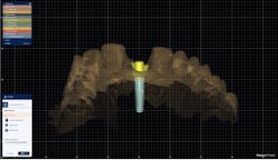 Figure 3: Designed abutment bottom Figure 3: Designed abutment bottom