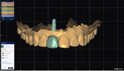 Figure 4: Completed provisional restoration design Figure 4: Completed provisional restoration design