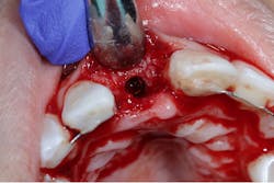 Figure 5: Final placement of implant via guided surgery Figure 5: Final placement of implant via guided surgery