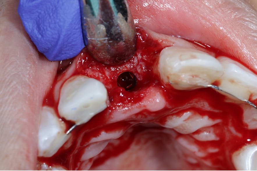 Figure 5: Final placement of implant via guided surgery