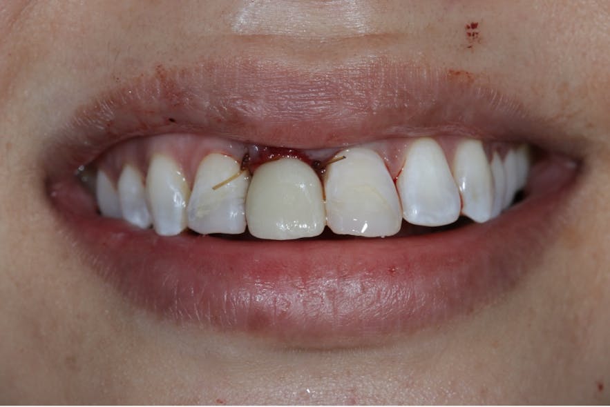 Figure 6: Provisional after implant placement. Provisional was prebonded to a titanium base and required only minimal occlusal adjustments.