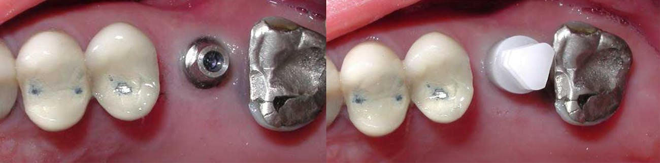 Figure 1: An abutment placed on the implant that will be used with an abutment-level impression (left) and the plastic impression coping snapped on the abutment (right).