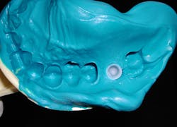 Figure 2: The abutment-level impression removed intraorally, demonstrating the abutment coping embedded in the impression with orientation flat present in the coping. Figure 2: The abutment-level impression removed intraorally, demonstrating the abutment coping embedded in the impression with orientation flat present in the coping.