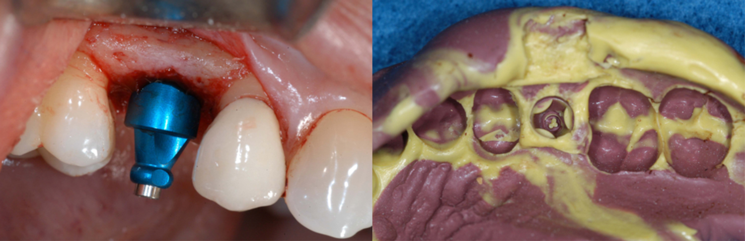 Figure 3: Closed-tray impression abutment inserted on the implant intraorally and the impression following removal intraorally.