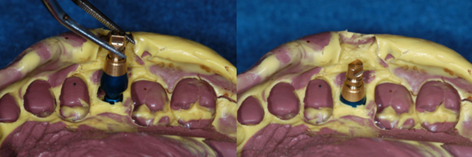 Figure 4: The closed-tray impression abutment placed on an implant analog being reinserted into the impression in the correct rotational orientation.