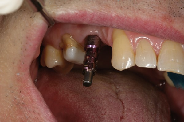 Figure 5: Open-tray impression abutment placed on the implant intraorally with its long pin that will emerge through the tray.