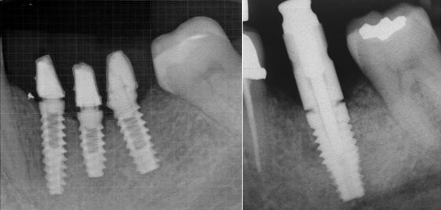 Figure 7: Radiograph demonstrating incomplete mating of the abutment heads on the middle and mesial implants, with proper mating on the distal implant (left) and miss-seating of an impression abutment (right).
