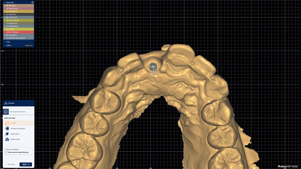 Digital implant planning with prefabricated immediate provisional: A ...