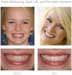 Figure 1: Alexandra&apos;s teeth looked small for her face. Now in college, she had been self-conscious about her smile for years and asked Dr. Arnold what she could do to make it better. He did a gum lift to raise her gumline, and did 12 porcelain veneers to make her teeth look longer. He didn&apos;t need to prepare the teeth at all. There was no grinding: he just placed porcelain veneers over her enamel.