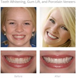 Figure 1: Alexandra's teeth looked small for her face. Now in college, she had been self-conscious about her smile for years and asked Dr. Arnold what she could do to make it better. He did a gum lift to raise her gumline, and did 12 porcelain veneers to make her teeth look longer. He didn't need to prepare the teeth at all. There was no grinding: he just placed porcelain veneers over her enamel. Figure 1: Alexandra's teeth looked small for her face. Now in college, she had been self-conscious about her smile for years and asked Dr. Arnold what she could do to make it better. He did a gum lift to raise her gumline, and did 12 porcelain veneers to make her teeth look longer. He didn't need to prepare the teeth at all. There was no grinding: he just placed porcelain veneers over her enamel.