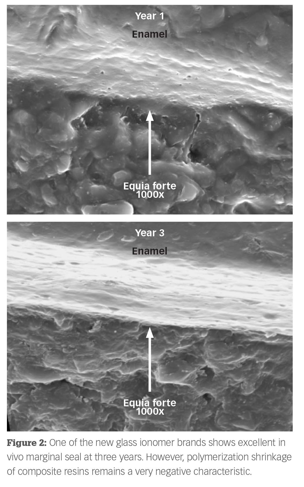 Are Flowable Composites Adequate Restorations? | Dental Economics