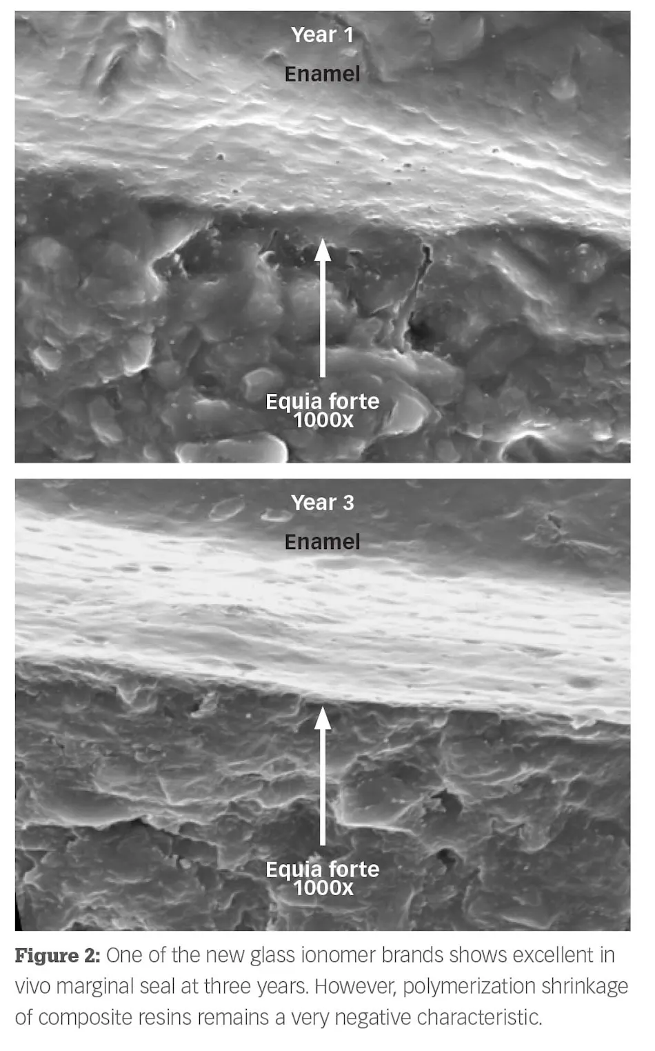 Flowable Composite Process Are flowable composites adequate restorations? | Dental Economics